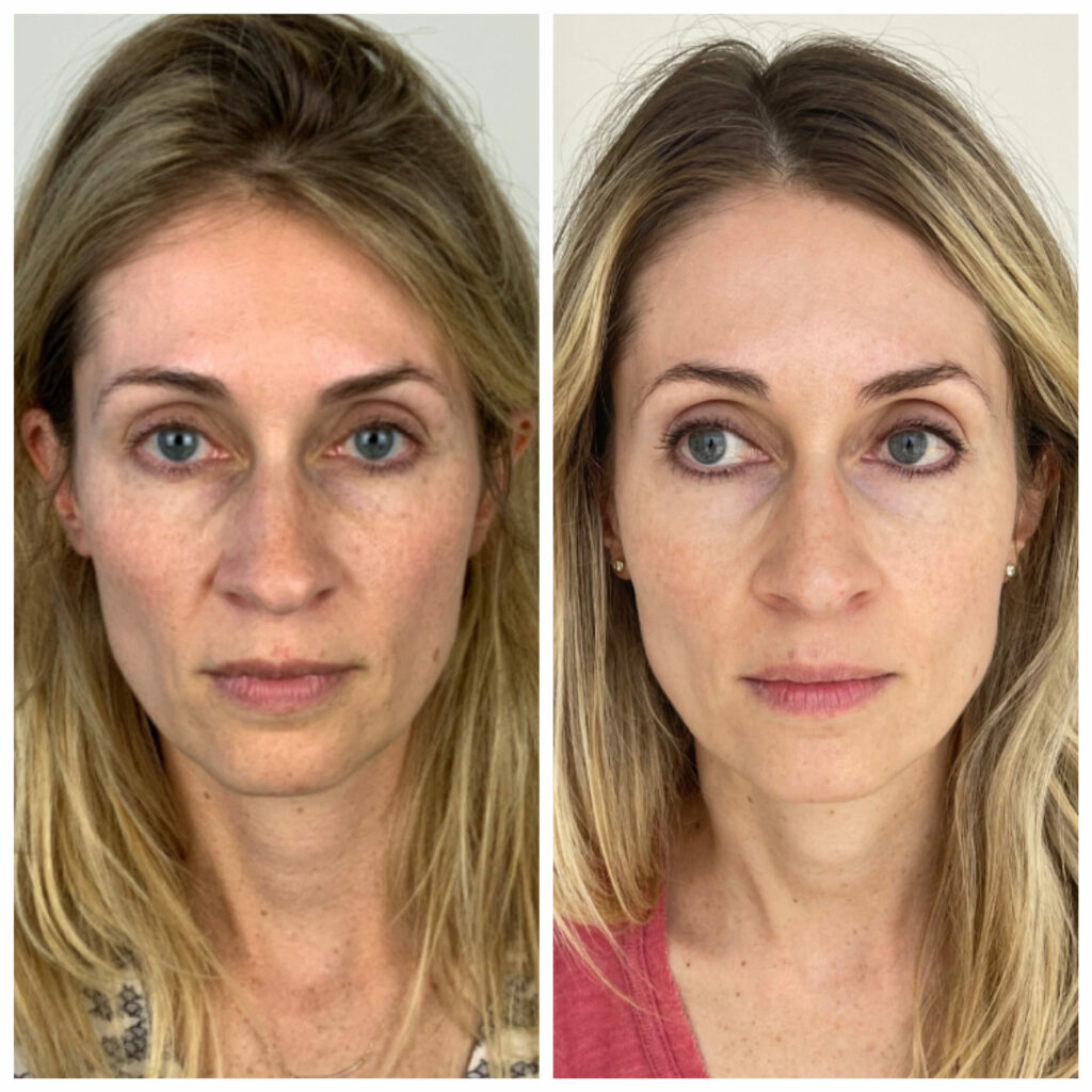 Overall skin tone/texture improvement from series of Clear + Brilliant Permea. We later did a series of Sculptra for facial volume loss.