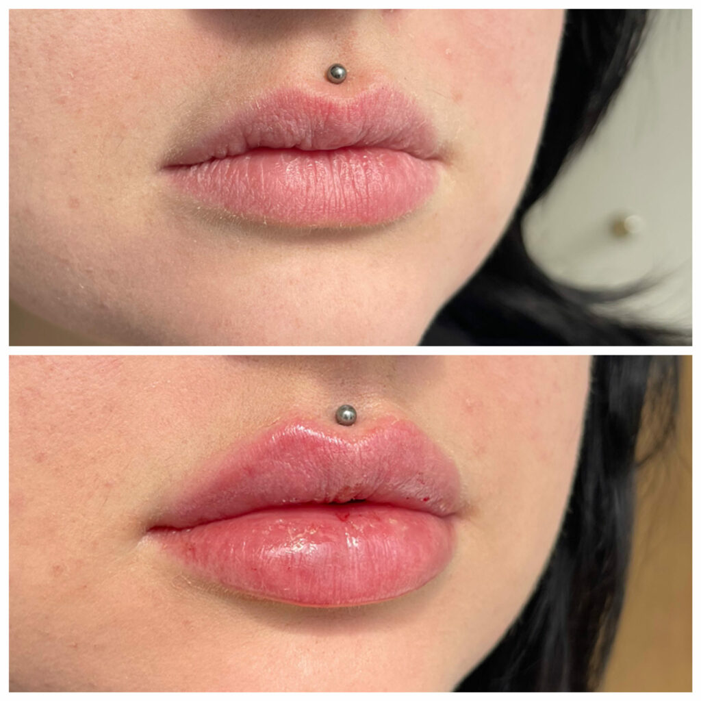 Natural looking Lip filler before and after in Denver Colorado