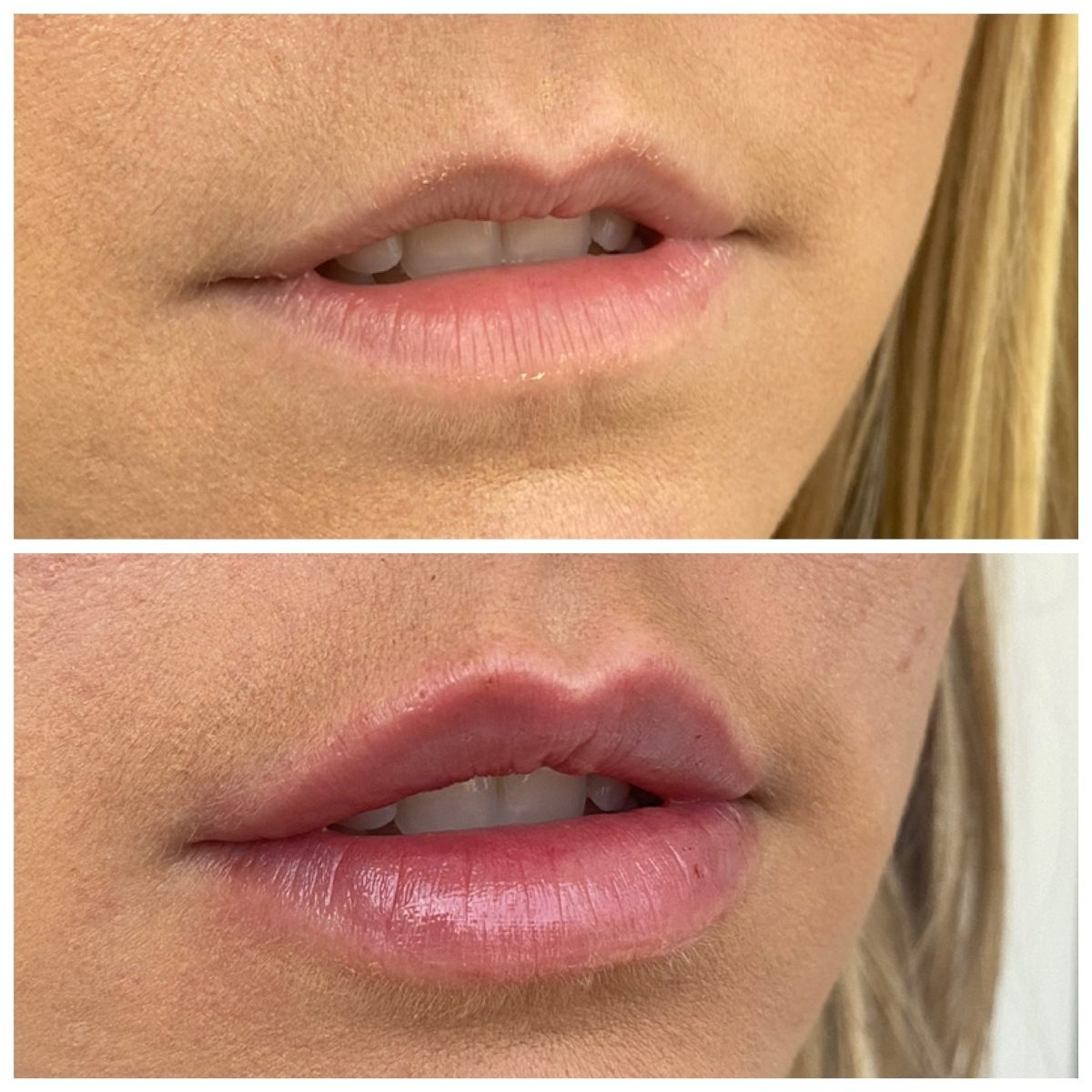 Can You Do Half A Syringe Of Dermal Filler 49 OFF