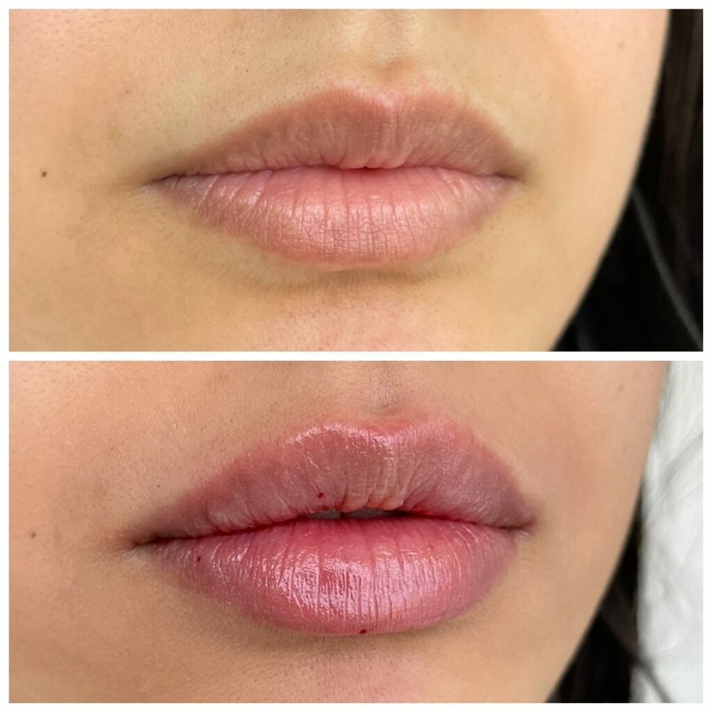 best lip filler injectors denver - boulder