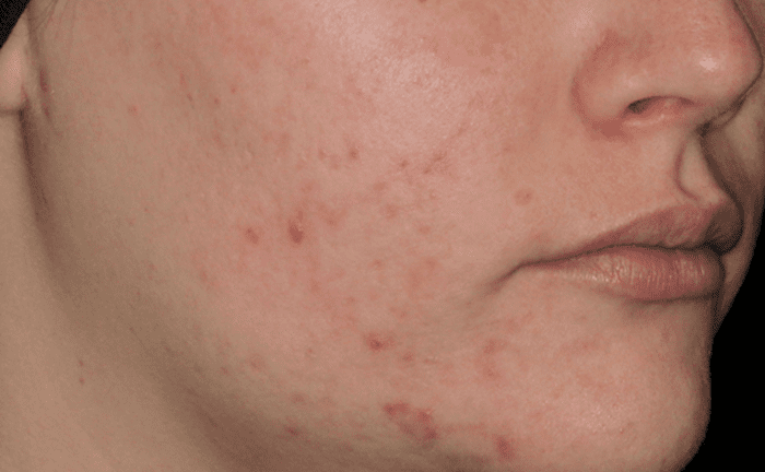 AviClear Acne Treatment Before After Denver Boulder 2