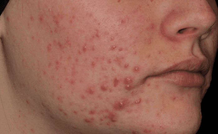 AviClear Acne Treatment Before After Denver Boulder