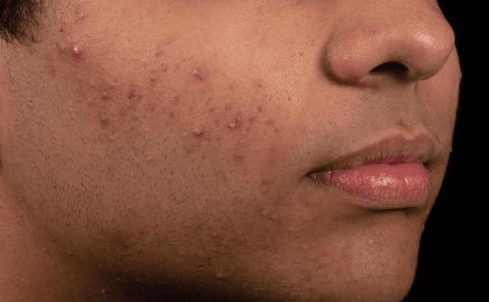 AviClear Acne Treatment Before After Denver Boulder 3