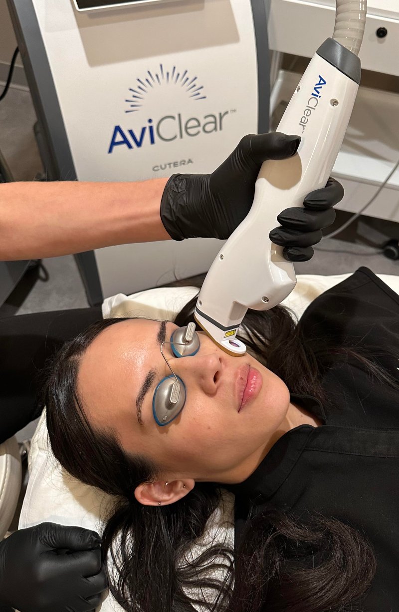 AviClear Acne Treatment in Denver and Boulder Colorado