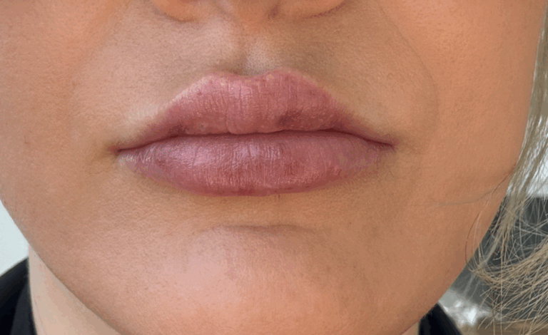 lip-filler-healing-2