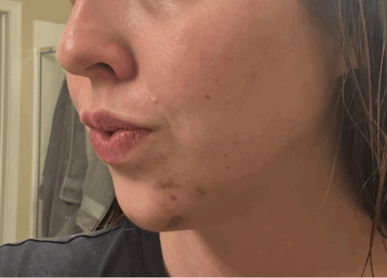 lip-filler-healing-3