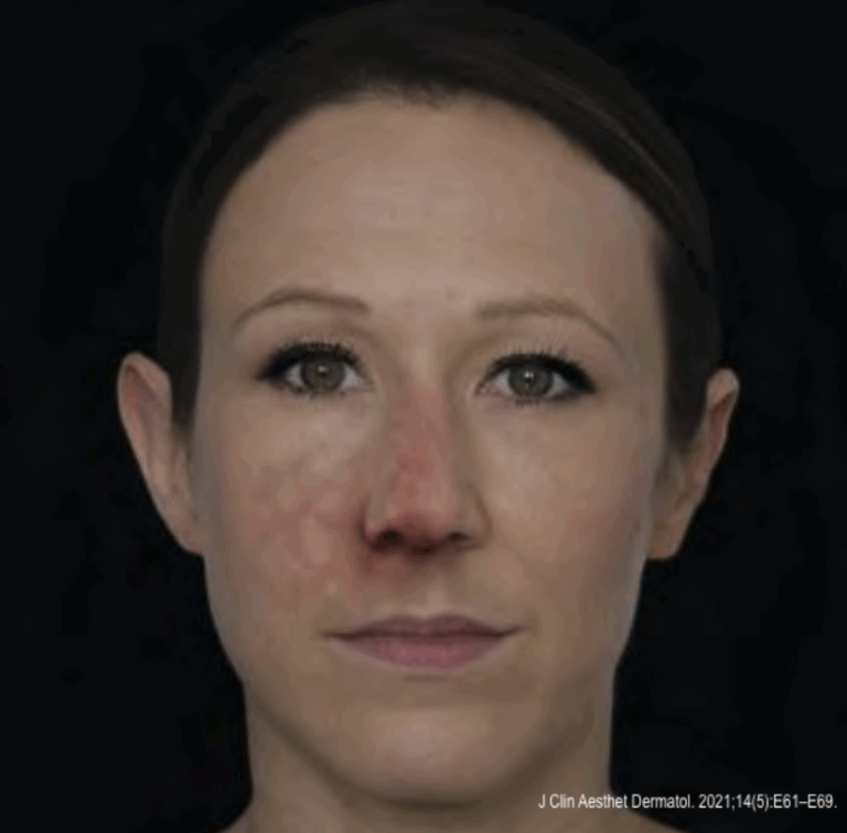 filler-complication-2