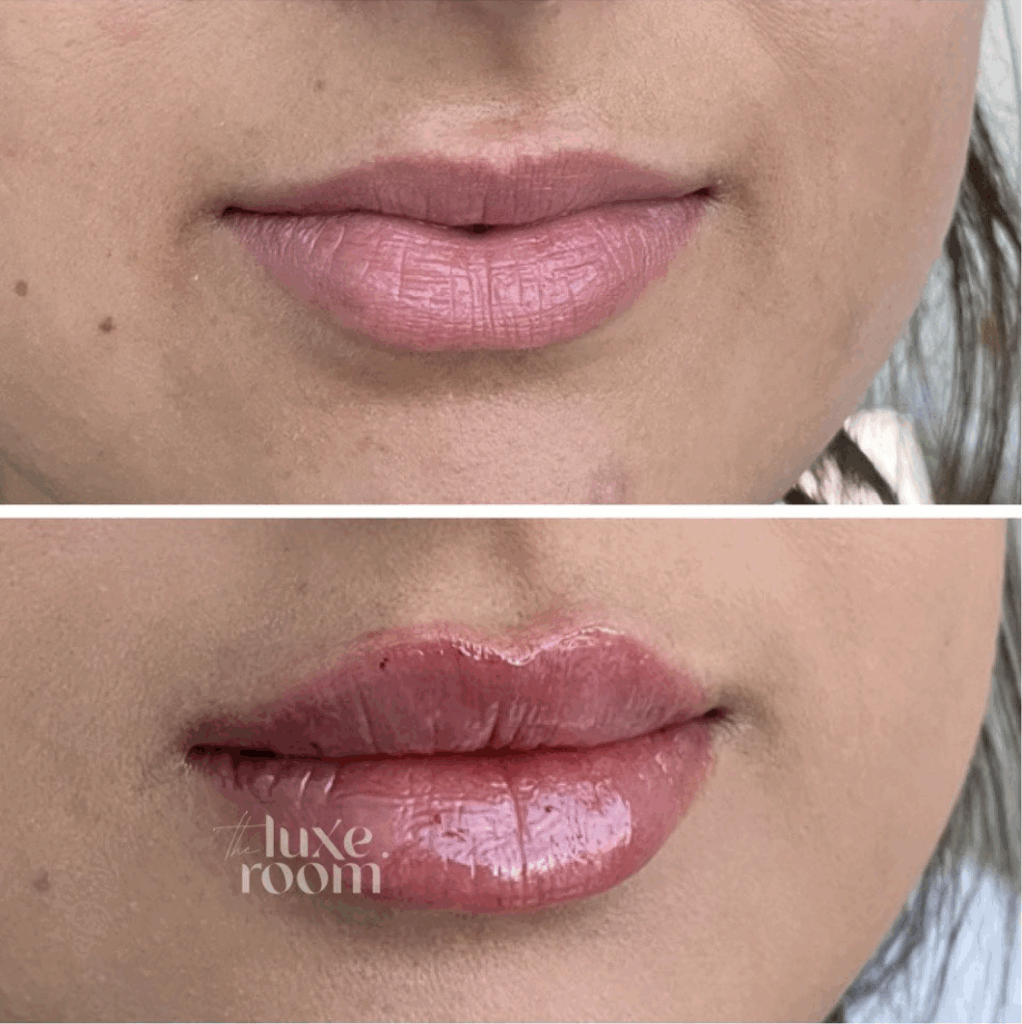 best-lip-filler-denver-medspa-2
