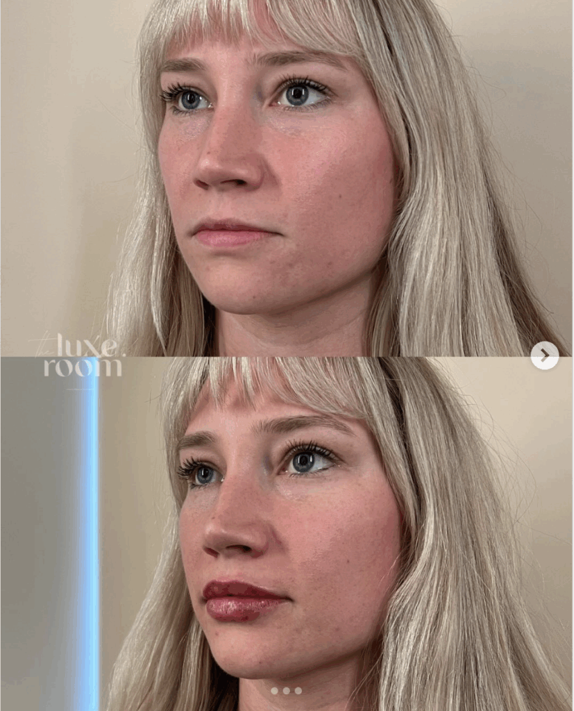best-lip-filler-denver-medspa-9